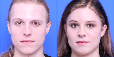 25-34 year old woman treated with MTF Facial Feminization Surgery - Browlift with Brow Bone Reduction and Hairline Advancement, Mandible Contouring, and Fat Transfer to multiple facial areas.