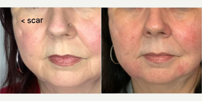 Woman treated with SkinPen - Woman treated with SkinPen.