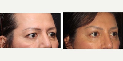 55-64 year old transgender woman treated with Eyelid Surgery, Forehead Reduction - Upper and lower blepharoplasty