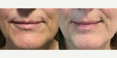 Woman treated with Restylane Kysse, Juvederm, Lip Fillers - Woman treated with Restylane Kysse, Juvederm, Lip Fillers
