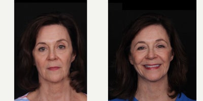 65-74 year old woman treated with Facelift, Neck Lift, Facial Fat Transfer - Love the subtle changes that an isolated face and neck lift with some fat grafting can bring! Our beautiful patient is now 8 months after surgery and continues to heal so well. Thanks to her for allowing us to share these photos!