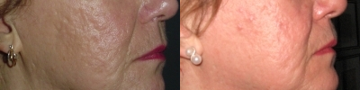 Smoothbeam laser - 
	Smoothbeam. The scars are markedly improved. The pigmented spots remain.

