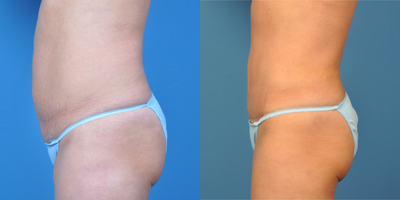 45-54 year old woman treated with Mini Tummy Tuck - Modified Abdominoplasty.