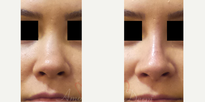 25-34 year old woman treated with Non Surgical Nose Job - Nonsurgical nose job (liquid rhinoplasty) to reshape the nose & sculpt nose bridge using Juvederm Voluma injection