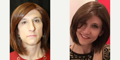 35-44 year old woman treated with Facial Feminization Surgery - Multiple facial procedures
