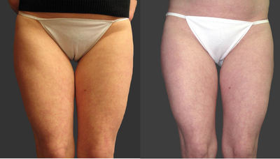 Exilis - 
	Exilis
