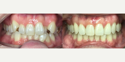 Patient treated with Braces - Patient treated with Braces