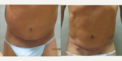 Man treated with Liposuction - Man treated with Liposuction