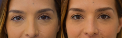 25-34 year old woman treated with Restylane - Scar revision using HA fillers