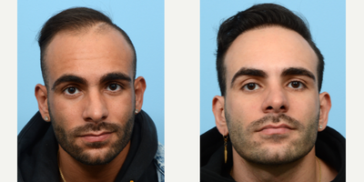 25-34 year old man treated with Hair Transplant, Hair Loss Treatment, PRP for Hair Loss, FUE Hair Transplant, NeoGraft - This 27-year-old patient was concerned with his rapidly receding hairline. Since he likes to keep his hair short, he opted for an FUE Hair Transplant, knowing he will have no visible scars as a result of this procedure. Dr. Wise also performed PRP to strengthen the follicles and expedite healing process. One year after receiving 2,525 grafts to his hairline, he's amazed by his rejuvenated appearance.