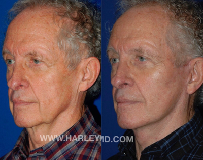 65-74 year old man treated with Facelift - Face and neck lift under local anesthesia in the office OR.