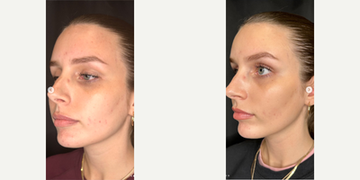 Woman treated with Chemical Peel, VI Peel - Woman treated with Chemical Peel, VI Peel