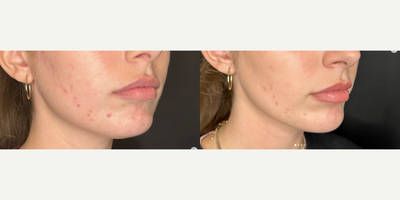 Woman treated with Chemical Peel, VI Peel - Woman treated with Chemical Peel, VI Peel