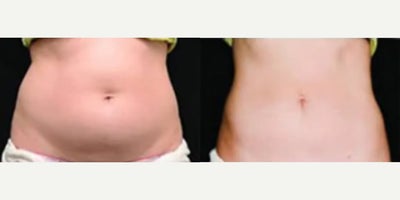 Woman treated with CoolSculpting - Woman treated with CoolSculpting. Patient is shown before and 9 weeks after second treatment.