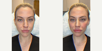 Woman treated with Facial - Woman treated with Facial