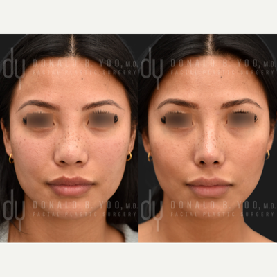 Asian Rhinoplasty with Rib cartilage and DCF - Before and After Revision Asian Rhinoplasty with rib cartilage and DCF (diced cartilage fascia). A diced cartilage fascia (DCF) graft was used to reshape and create greater definition.