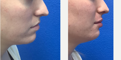 25-34 year old woman treated with Lip Fillers - Female in her 20s wants increased lip volumeDetails: Lip filler to improve lip fullness to make them look prettier/more feminine and reduce upper tooth show when she smilesShort summary: Lip filler to increase lip appearance