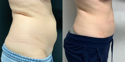 Woman treated with Liposuction - Liposuction