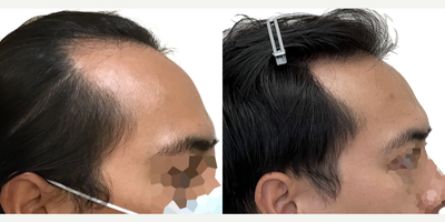 25-34 year old man treated with Rogaine - This is a 29-year-old male patient who came to us with a 4-year history of hair loss, with a significant recession of his frontal and temporal (side) hairlines. This resulted in the appearance of deep recessions that, even before age 30, were extending well behind his ears.Hed already started finasteride about a year before his surgery and noticed that his hair loss had stopped. He had no side effects from this medication.We did an 1800 graft FUE procedure to advance his frontal hairline only, which effectively brings it down along the sides to improve the deep recessions. He didnt want to bring the temporal (side) hairlines forward just in case he had future recession in that area behind the transplanted hair. His result (shown at 1-year post-op)! Even though we only advance the frontal hairline by about 1cm (as seen on the surgical markings), you can see from the photo markings that his hairline was brought significantly closer to his eyes, and the frontal-temporal points are now well ahead of his ears, instead of behind them. The overall result is very natural and very masculine looking, and is sure to continue to be well into the decades ahead. Immediately following his surgery he was also started on high-strength topical minoxidil to further enhance his surgical result, and this patient is continuing on that combination of finasteride and minoxidil to keep his hair looking great for decades to come.
