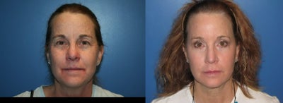 Microlaser Peel, Profractional Laser, and Broad Band Light treament - 
	This patient is a 55 year old female who underwent a series of Microlaser Peels, Broad Band Light treatments, and a Profractional Laser treatment for the reduction of wrinkles and hyperpigmented areas of the skin.
