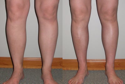 Liposuction of ankles and calves - 31 year old preop and 4 months postop liposuction of ankles and legs. Note the improved definition and shape of the legs.