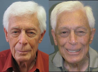 Lite Lift (TM) - 
	Like many other advertised modified facelifts, the Lite-lift&trade; is a procedure that reduces signs of aging of the lower face, jawbone, and neck. Patients looking for affordable and quick facial rejuvenation should take a serious look at our Lite-lift&trade;.
