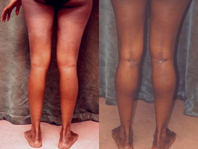 Women's Calf Augmentation  - 
	Women&#39;s Calf Augmentation W/Implants
