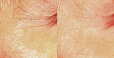 Woman treated with Pelleve - Woman treated with Pelleve