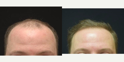 35-44 year old man treated with NeoGraft - 35-44 year old man treated with NeoGraft procedure with 2,000 grafts harvested.