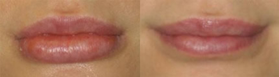 Lip Surgery, Lip Reduction - 
	This is a case of severe lip excess from inappropriate injection of silicone or other substances. Patient complains of overly large lips and deformity. After careful and artistic lip reduction.
