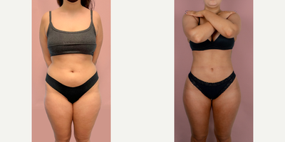 18-24 year old woman treated with Liposuction - This patient is shown 2 months after 360 Lipo & Brazilian butt lift. 750mL of fat was transferred into each buttock/hip dip.