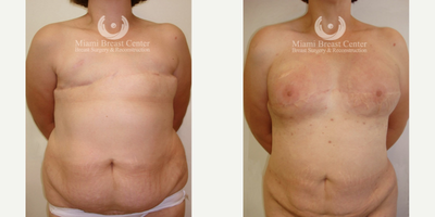 35-44 year old woman with Breast Reconstruction and fat grafting - 42 year old woman with bilateral mastectomy and radiation. She began her delayed reconstruction about 6 years after her mastectomy. She was able to regenerate her natural breasts after various BRAVA + AFT sessions. These sessions were able to reverse the radiation fibrosis and the tightness in her chest. She now has natural, soft, bouncy breasts and improved her overall shape with the liposuction.