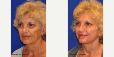 Laser Treatment - Laser Treatment