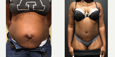 28 year old woman treated with Umbilical Hernia Repair - Developed a pronounced weakness of the abdominal wall after childbirth. She had a large umbilical Hernia which became more apparent after her last pregnancy.In surgery she was found to have continuation of the umbilical defect to the mid abdomen.