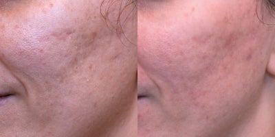 35-44 year old woman treated with Pulsed Dye Laser, Bellafill, Fraxel Laser - This patient presented for acne treatment. Following a series of photo dynamic therapy treatments, once active acne was the patient was treated with a series of vascular laser treatments to improve redness, Fraxel 1550nm laser and Bellafill semi-permanent filler to improve scars.