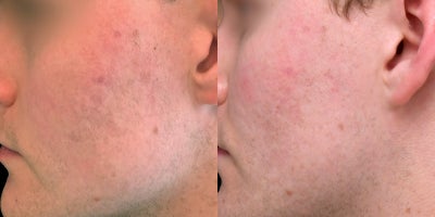 25-34 year old man treated with Photodynamic Therapy, Pulsed Dye Laser - This patient presented for acne treatment. Following a series of photo dynamic therapy treatments, once active acne was the patient was treated with a series of vascular laser treatments to improve redness.