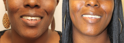 Dimple Creation - Right Cheek Dimple Creation