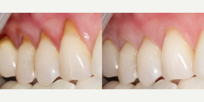 PST for Gum Recession - The Pinhole Surgical Technique (PST) is a scalpel-free, suture-free procedure for correcting gum recession. A small hole is created above the receding gum line, and Healthy gum tissue is gently loosened and re-positioned over the receded part of the tooth. Since there is no cutting or stitching, patients experience minimal post-operative pain with little swelling or bleeding. Optimal results are achieved after 6 weeks of healing. PST patients are pleasantly surprised by the instant cosmetic improvement in their smile.