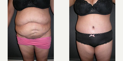 Woman treated with Tummy Tuck - This young mother was unhappy with the large rolls on her tummy, with excess skin and fat. An abominoplasty (tummy tuck) flattened her tummy and improved her shape dramatically.