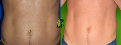 35-44 year old man treated with Velashape - 4 sessions of VelaShape III