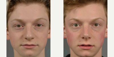 Woman treated with Septoplasty - By Dr. James Marotta