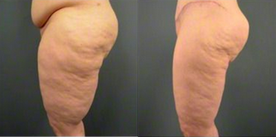 35-44 year old woman treated with Body Jet - A patient with full body hi definition VASER/Body Jet Liposuction and Fat Transfer for Cellulite