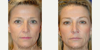 Woman treated with Liquid Facelift - Woman treated with Liquid Facelift
