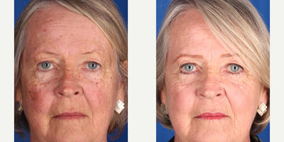 75 and up year old woman treated with Excel V and IPL - 75 and up year old woman treated with Excel V and IPL
