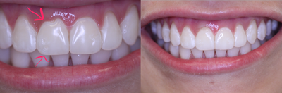 25-34 year old woman treated with Epic Diode Laser Gum Sculpting and cosmetic Bonding - Dr. Steven Davidowitz of Luxury Dentistry NYC used this technique to correct the gum unevenness of the right central incisor with a cosmetic gum lift. This procedure using the latest in diode dental Laser technology was completed without any shots or numbing and without any patient discomfort! Cosmetic bonding was then completed to correct voids found in the enamel at the gum line and at the middle to end of the tooth. The after photo was taken immediately post procedure, notice how there is no bleeding, swelling or irritation where the gum lift was just completed!