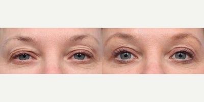 35-44 year old woman treated with Eyelid Surgery - Dr. Wise performed an upper blephoraplasty on this 47-year-old patient who was complaining of sagging eyelids. Her results show a youthful, refreshed appearance.