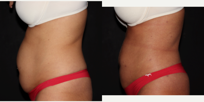 35-44 year old woman treated with Laser Liposuction with Renuvion Skin Tightening to the Abdomen and Flanks - Cosmetic Liposuction patient 6 weeks after liposuction with Renuvion skin tightening to the abdomen and flanks.