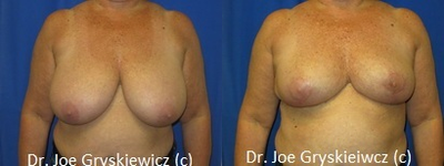 Breast Reduction - Age: 56 Height: 5'2 Weight: 160-165lbs. Size preop: 38DDD    Size postop: 38C