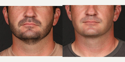 Platysmaplasty to tightenand contour the neck. - Platysmaplasty to tightenand contour the neck.