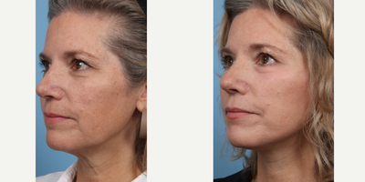 45-54 year old woman treated with Deep Plane Facelift, CO2 Laser - Deep Plane Facelift and Co2 Laser to Lower Eyelids